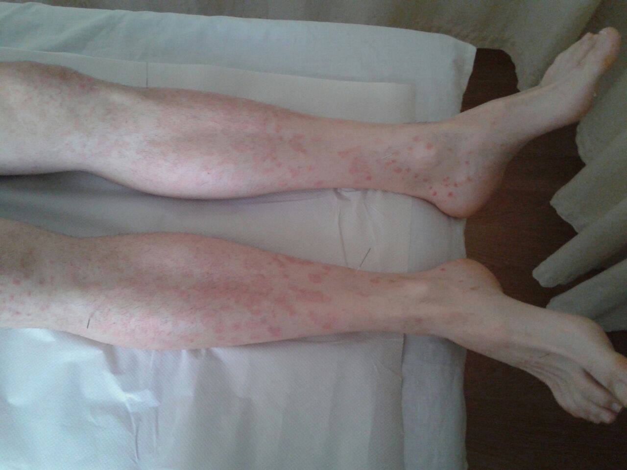 Antes del tratamiento